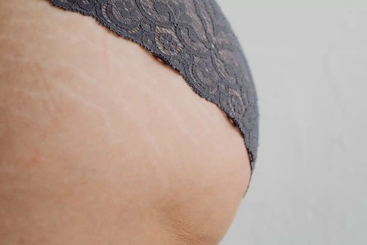 grossesse  vergetures